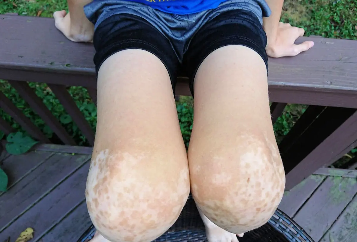 vitiligo causes