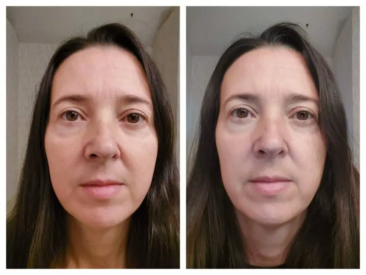 3 months after sofwave