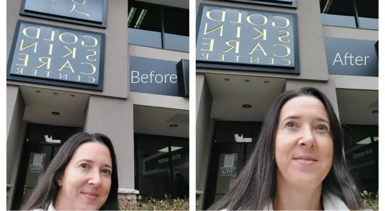 sofwave before and after treatment