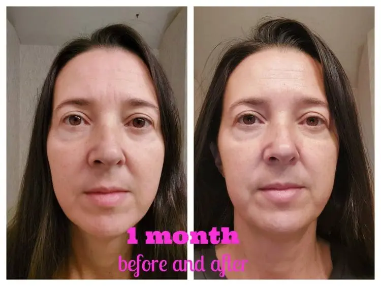 1 month after Sofwave